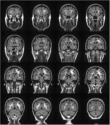 Multidisciplinary Rehabilitation is Efficacious and Induces Neural Plasticity in Multiple Sclerosis even when Complicated by Progressive Multifocal Leukoencephalopathy